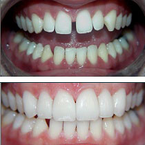 ba-patrick-veneers family and cosmetic dentistry