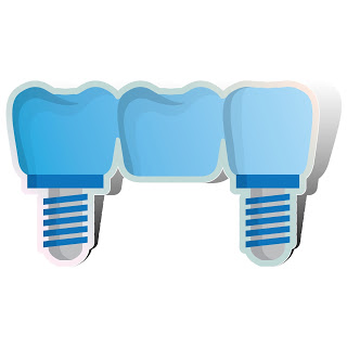 what is a dental implant