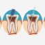 root canal