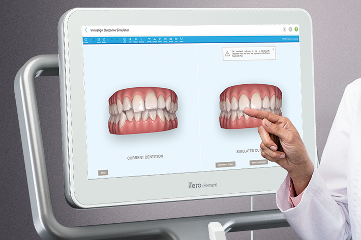 Photo of a computer screen, showing the iTero technology 3D scan of a patient's teeth.